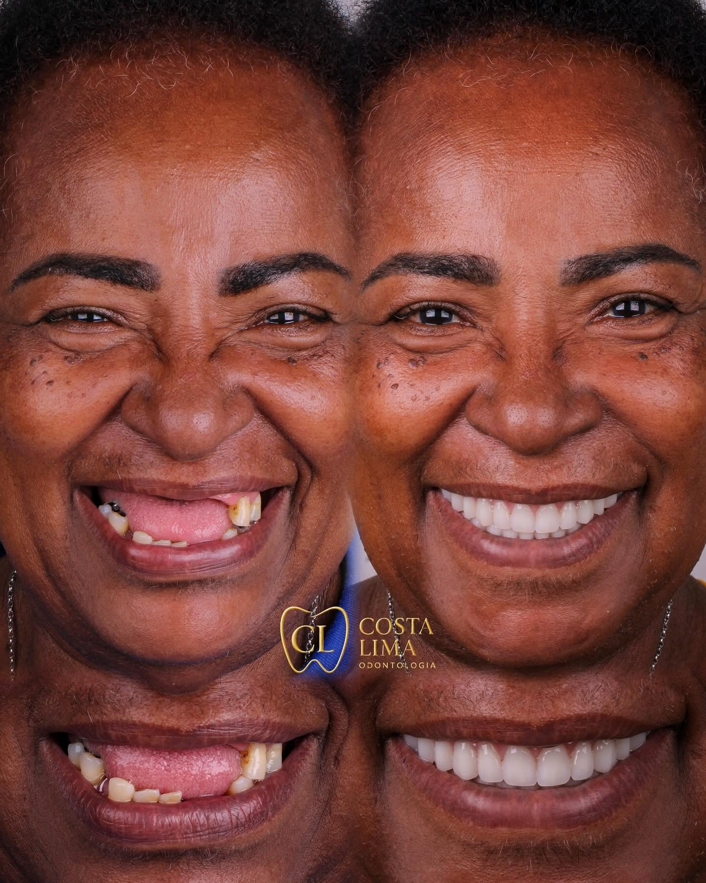 Implante dentário em Madureira na Costa Lima Odontologia